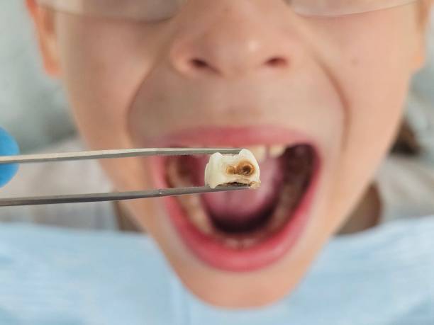 Best Emergency Root Canal Treatment in North Les, AK